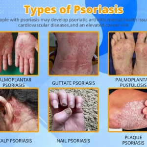 Cvreoz® Bee Venom Psoriasis Treatment Spray