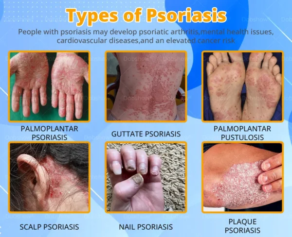 Cvreoz® Bee Venom Psoriasis Treatment Spray
