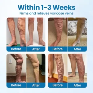Cvreoz® VeinGuard Herbal Spray-Visible Results in 7 Days or Less