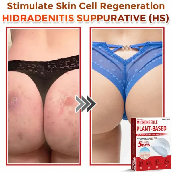 Juxek™ MicroNeedle Plant-based Skin Tag Removal Patch 🇺🇸 Made in the USA