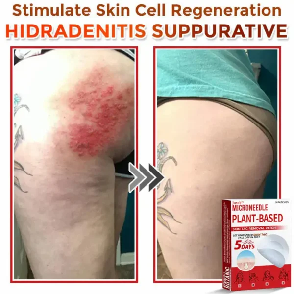 Juxek™ MicroNeedle Plant-based Skin Tag Removal Patch 🇺🇸 Made in the USA