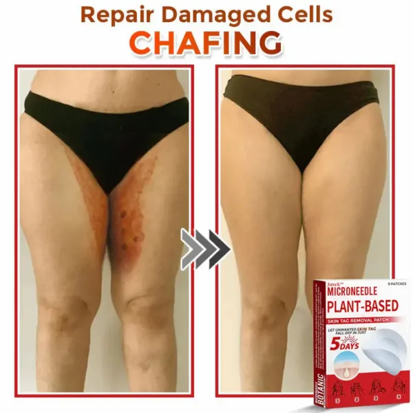 Juxek™ MicroNeedle Plant-based Skin Tag Removal Patch 🇺🇸 Made in the USA