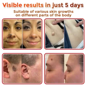 Juxek™ MicroNeedle Plant-based Skin Tag Removal Patch 🇺🇸 Made in the USA