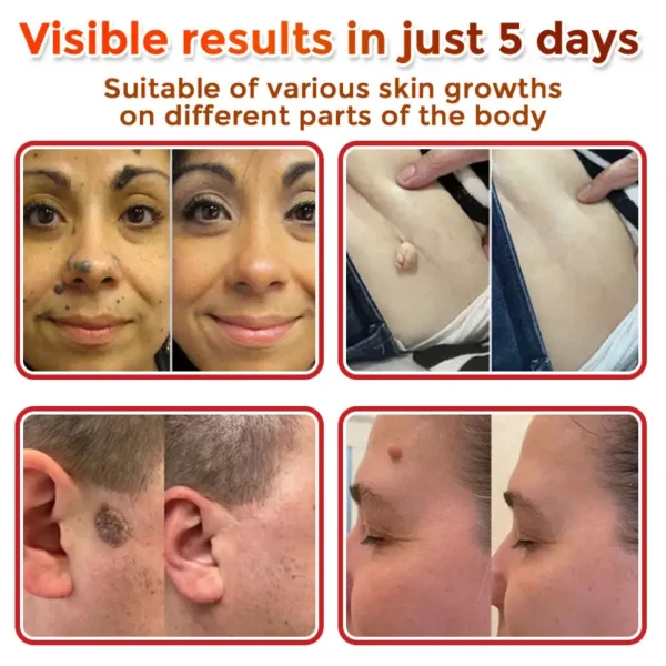 Juxek™ MicroNeedle Plant-based Skin Tag Removal Patch 🇺🇸 Made in the USA