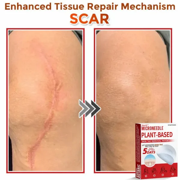 Juxek™ MicroNeedle Plant-based Skin Tag Removal Patch 🇺🇸 Made in the USA