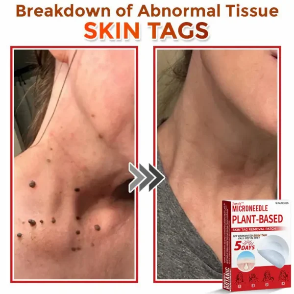Juxek™ MicroNeedle Plant-based Skin Tag Removal Patch 🇺🇸 Made in the USA