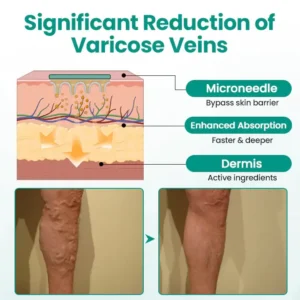 Newyuo® LegRenew Varicose Veins Patch